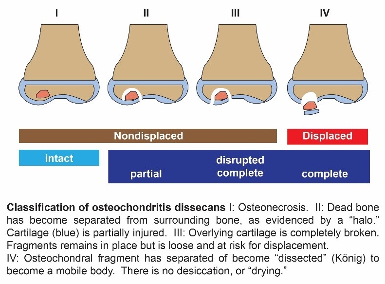 osteochondritis